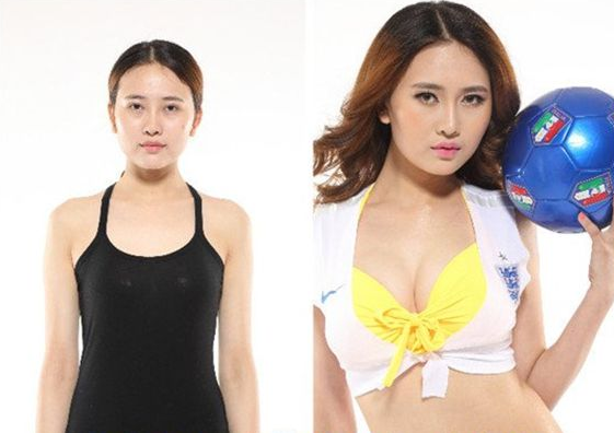 矽膠豐胸會有什麽危害 矽膠豐胸會有什麽危害